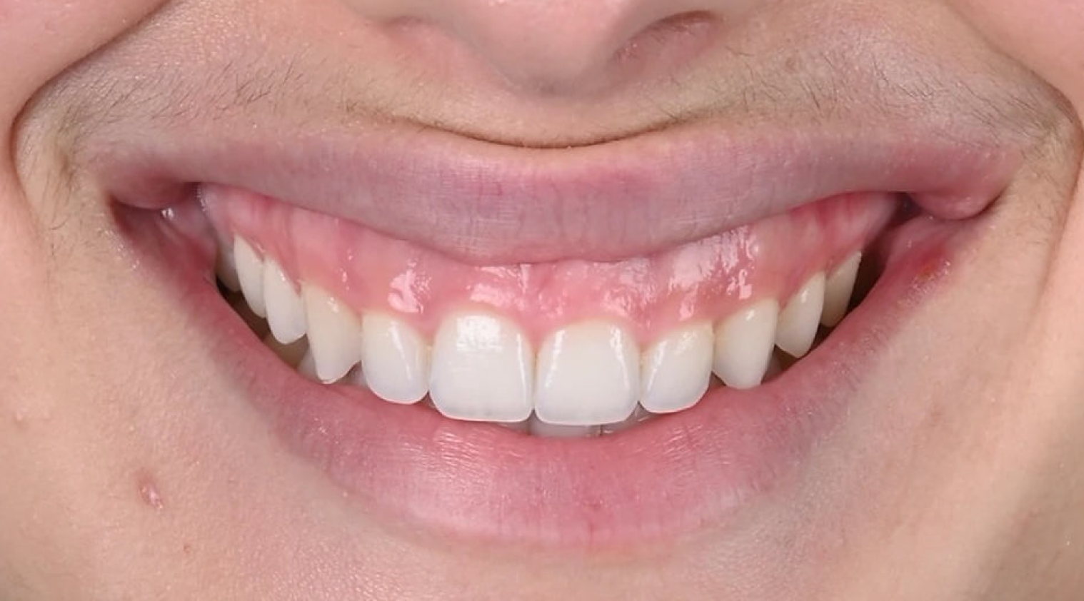 Gingivoplastia Antes