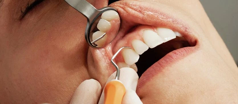 Apicectomia en sevilla proceso