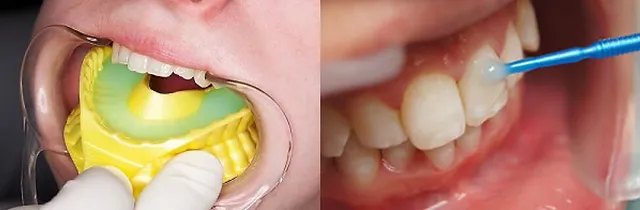 Aplicación de flúor dental ninos