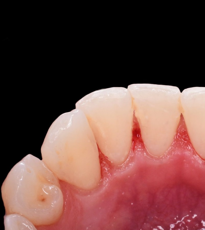 CURETAJE-DENTAL-ANTES-2