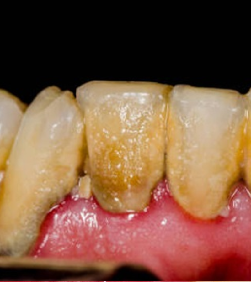 CURETAJE-DENTAL-ANTES-DESPUES-1