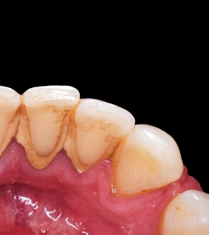 CURETAJE-DENTAL-ANTES-DESPUES-2