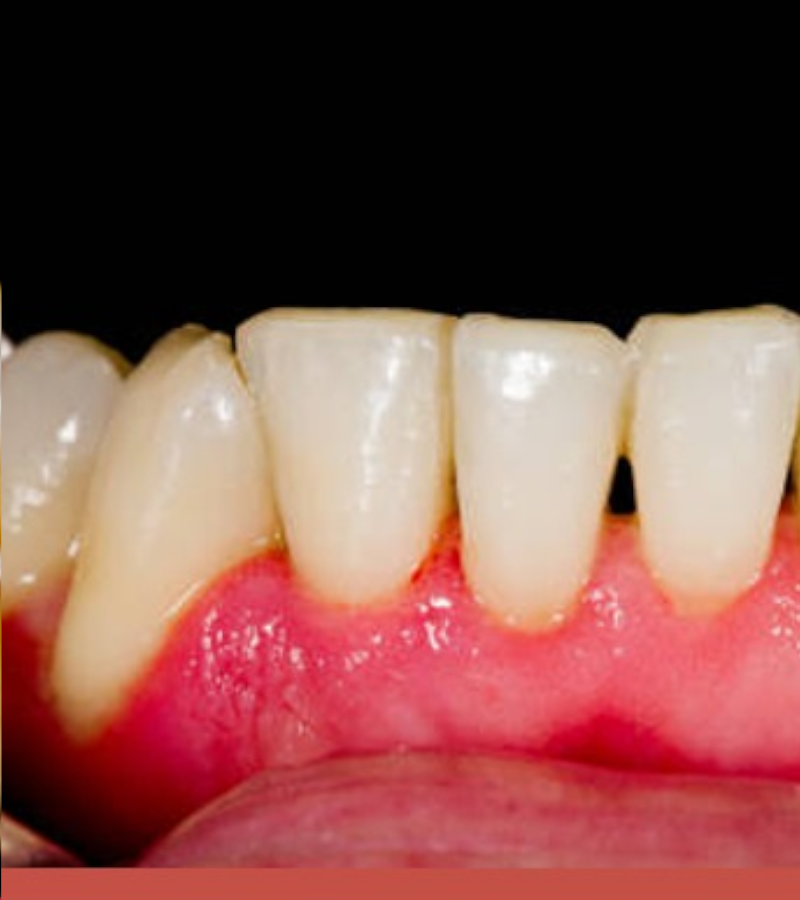 CURETAJE-DENTAL-ANTES-Y-DESPUES-2