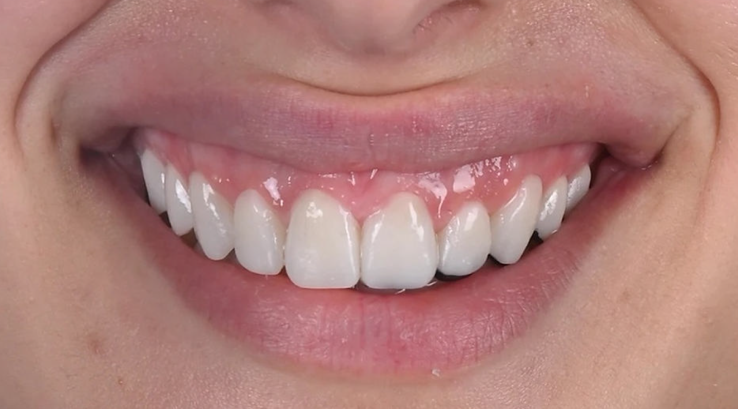 Gingivoplastia Despues