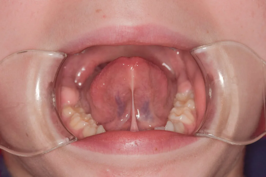 Frenectomía sevilla