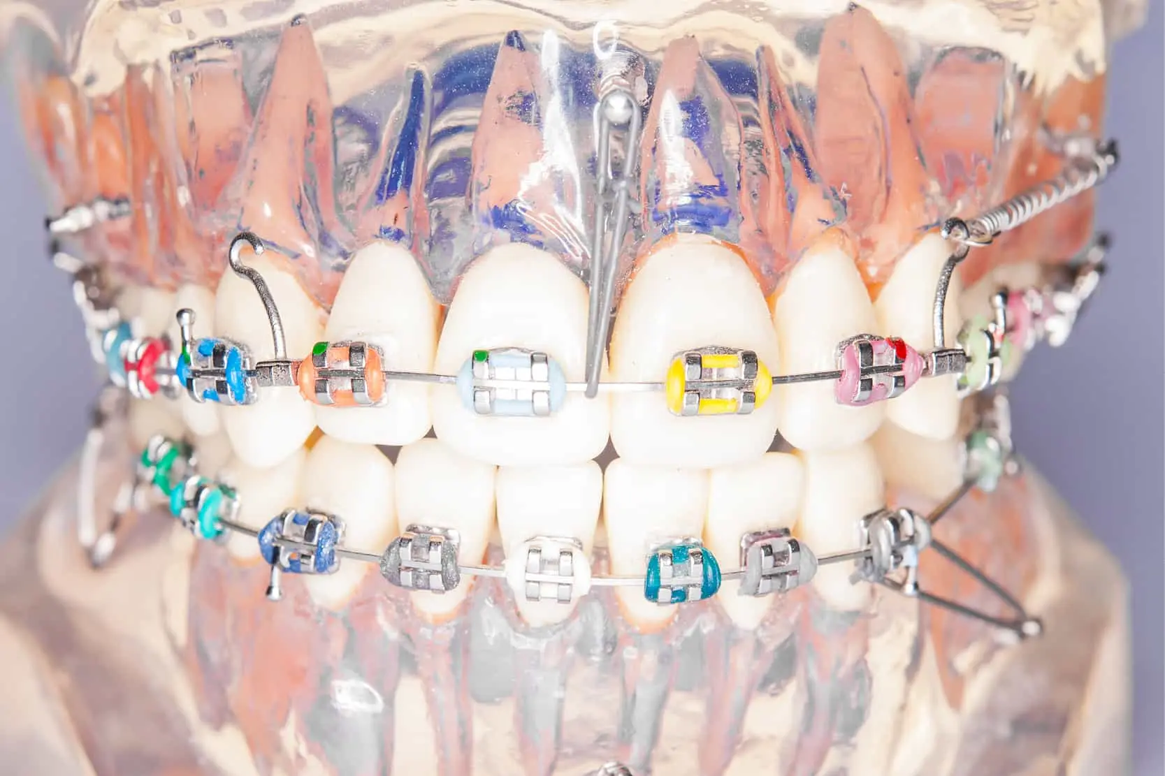 Micoimplante dental que son