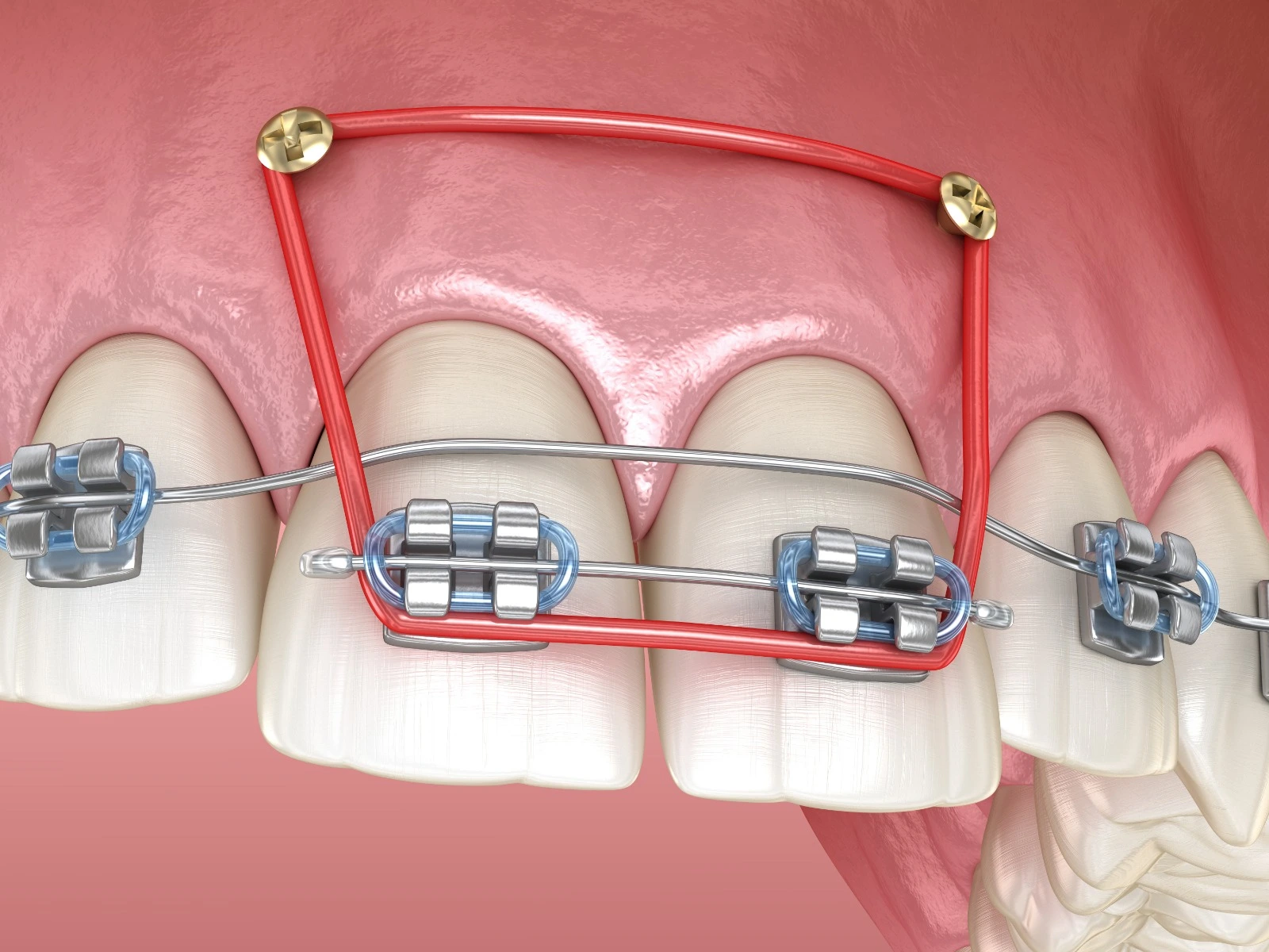Microimplantes dentales que son