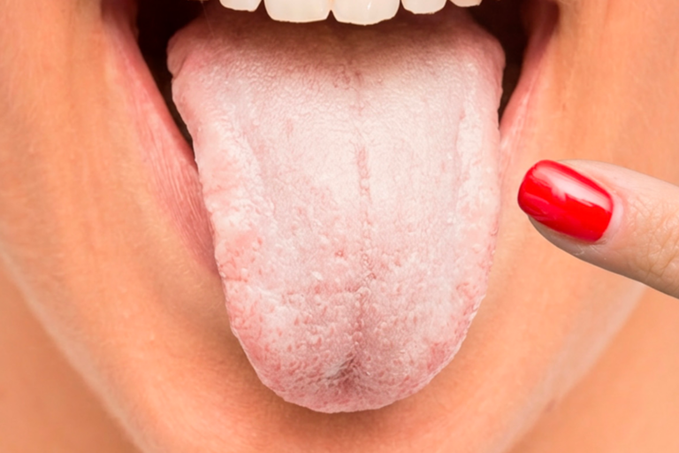 PORQUE TENGO LA LENGUA BLANCA