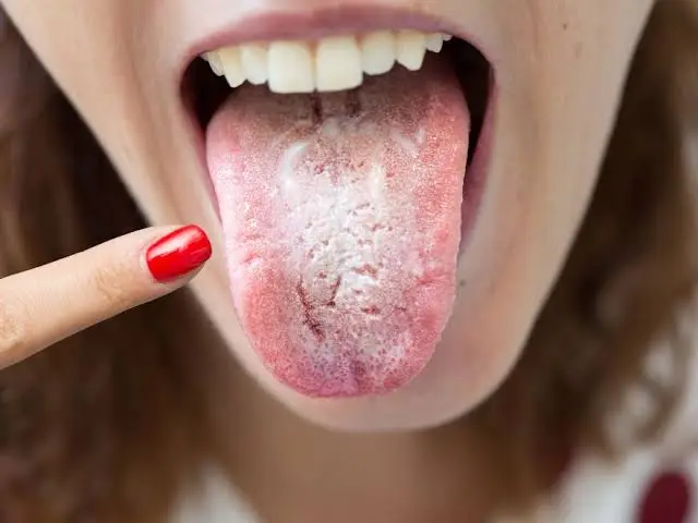 Que-significa-tener-la-lengua-blanca