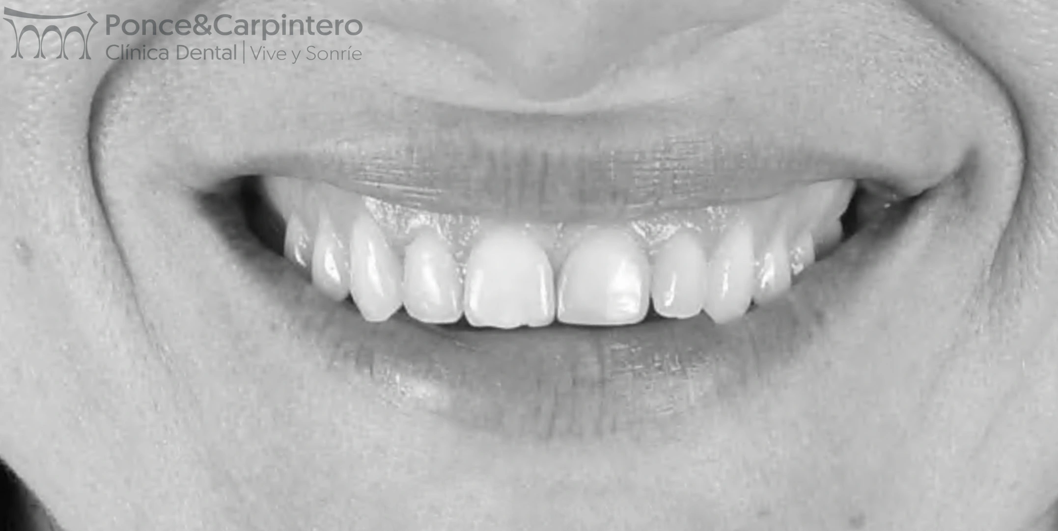 antes-carillas-feldespaticas