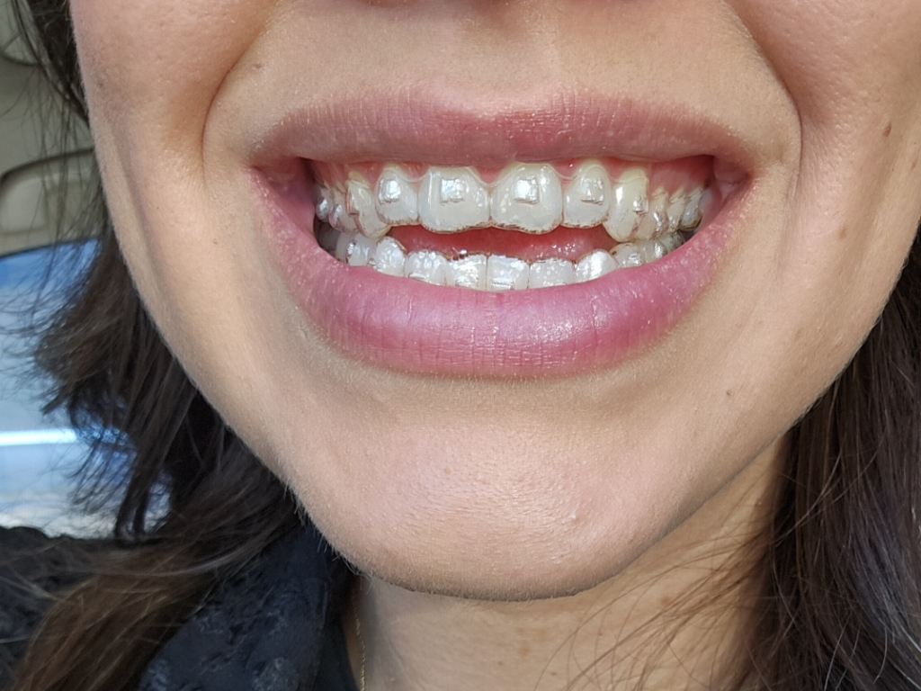 attachments-invisalign