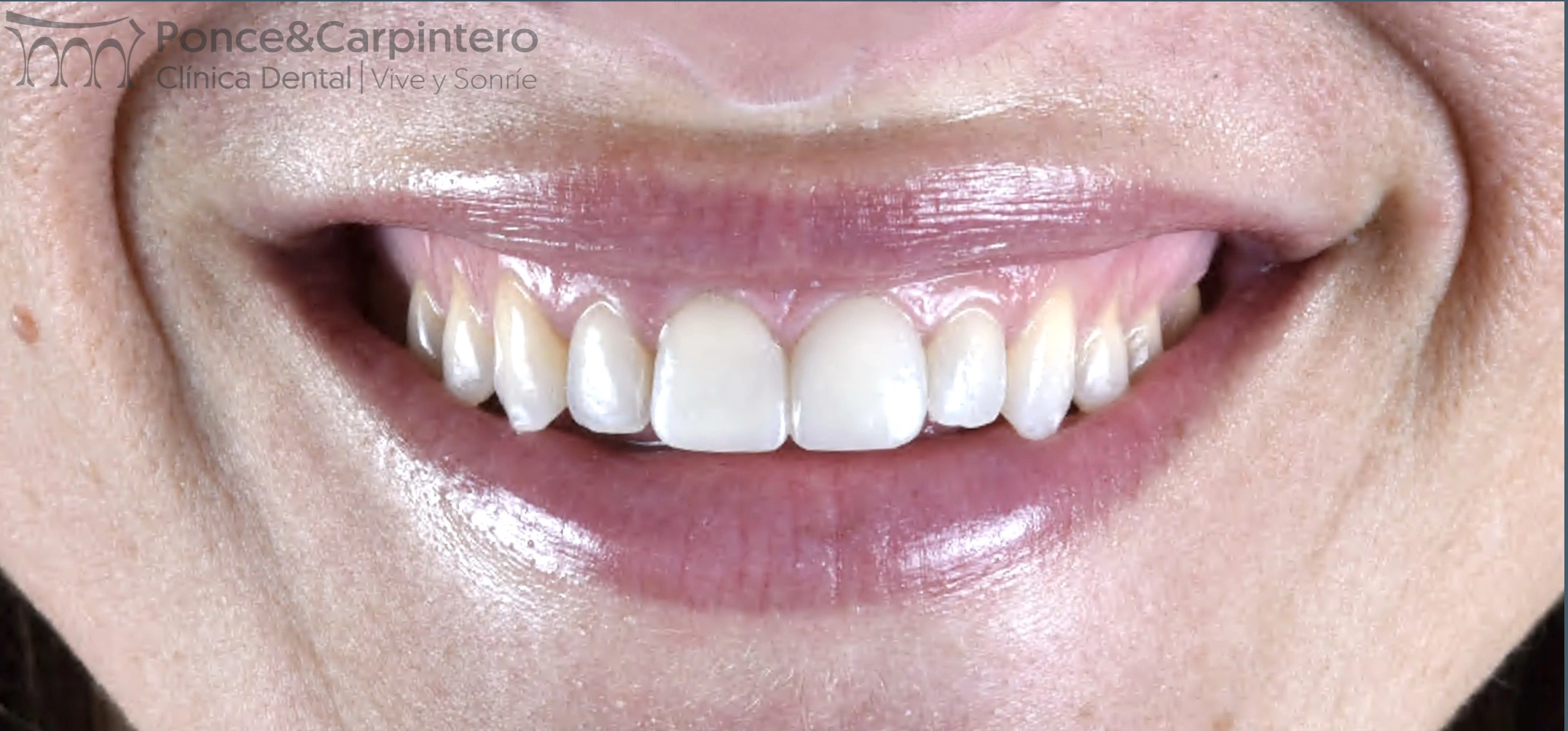 despues-carillas-feldespaticas