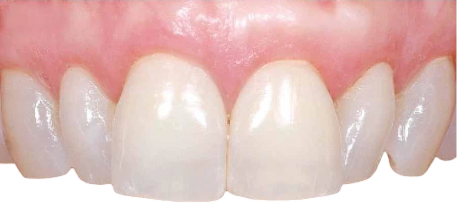 encias retraidas antes y despues 2