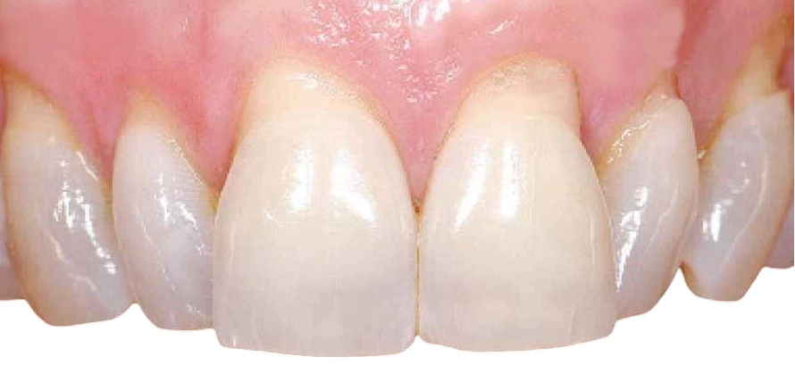 encias retraidas antes y despues