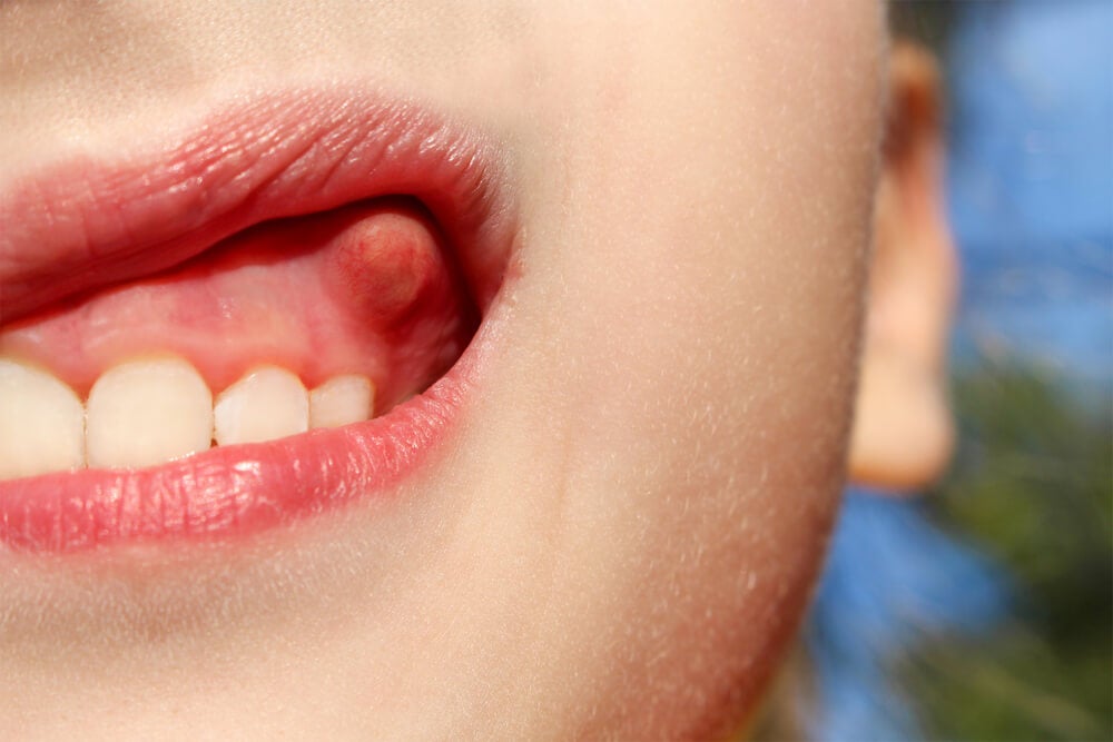 flemon o abceso dental