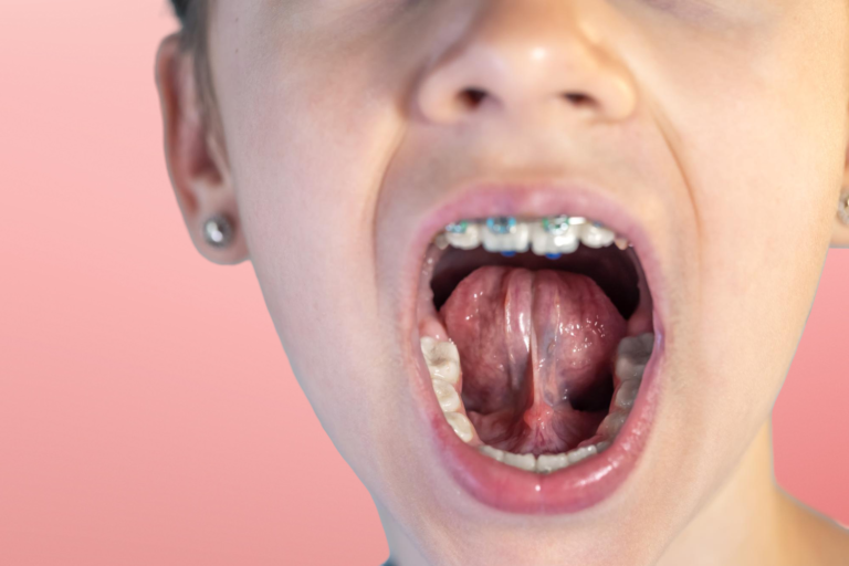 frenillo lingual sevilla