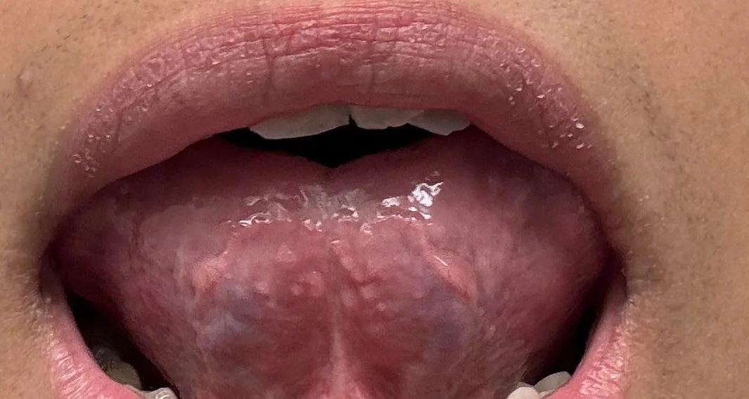 granitos debajo de la lengua