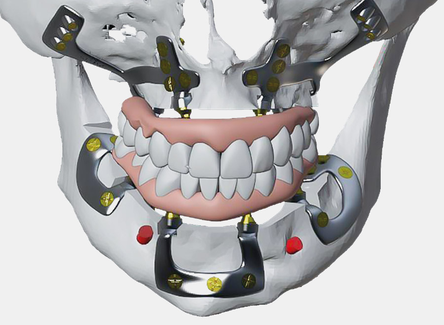 implantes corticales en sevilla