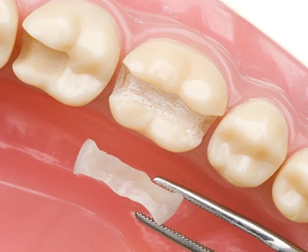 incrustacion-dental-inlay