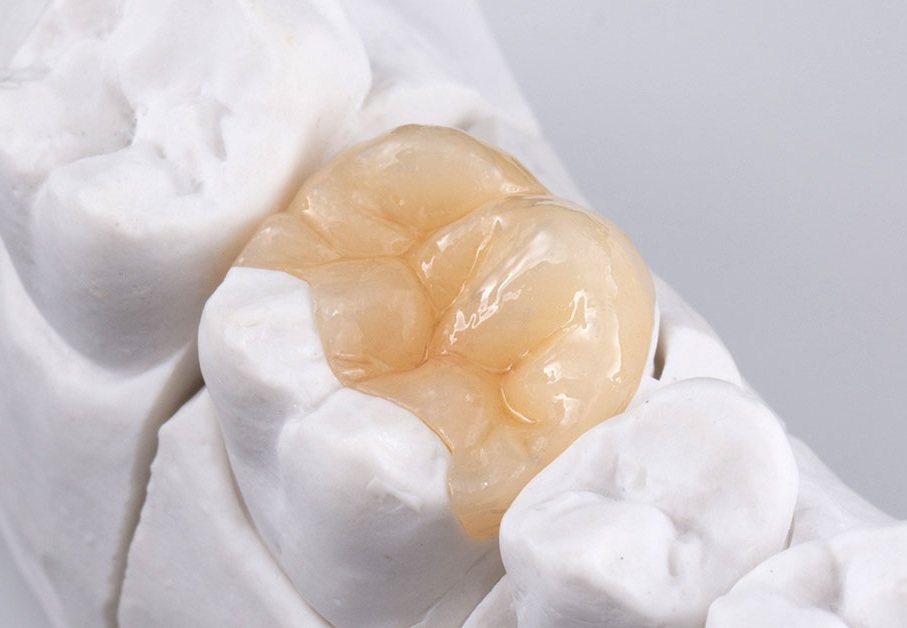 incrustacion-dental-onlay