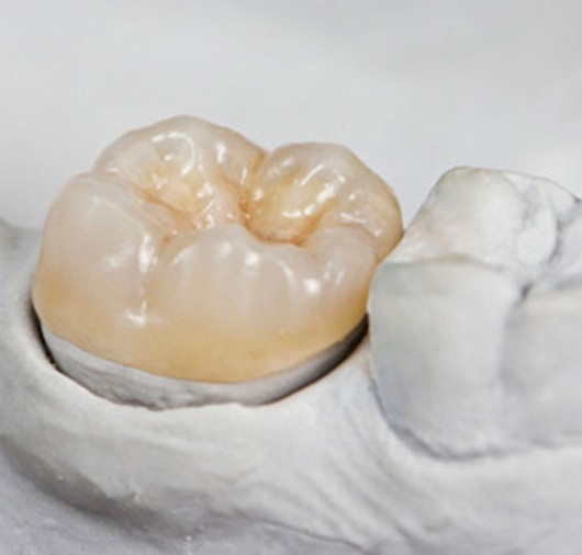 incrustacion-dental-overlay