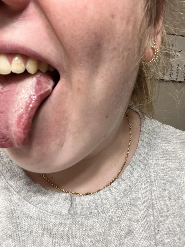 llagas en la lengua 3