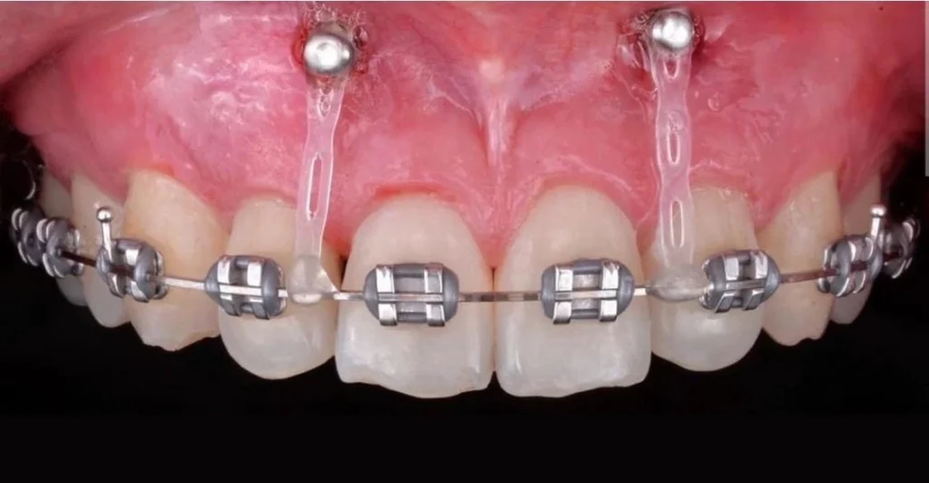 microtornillos-ortodoncicos