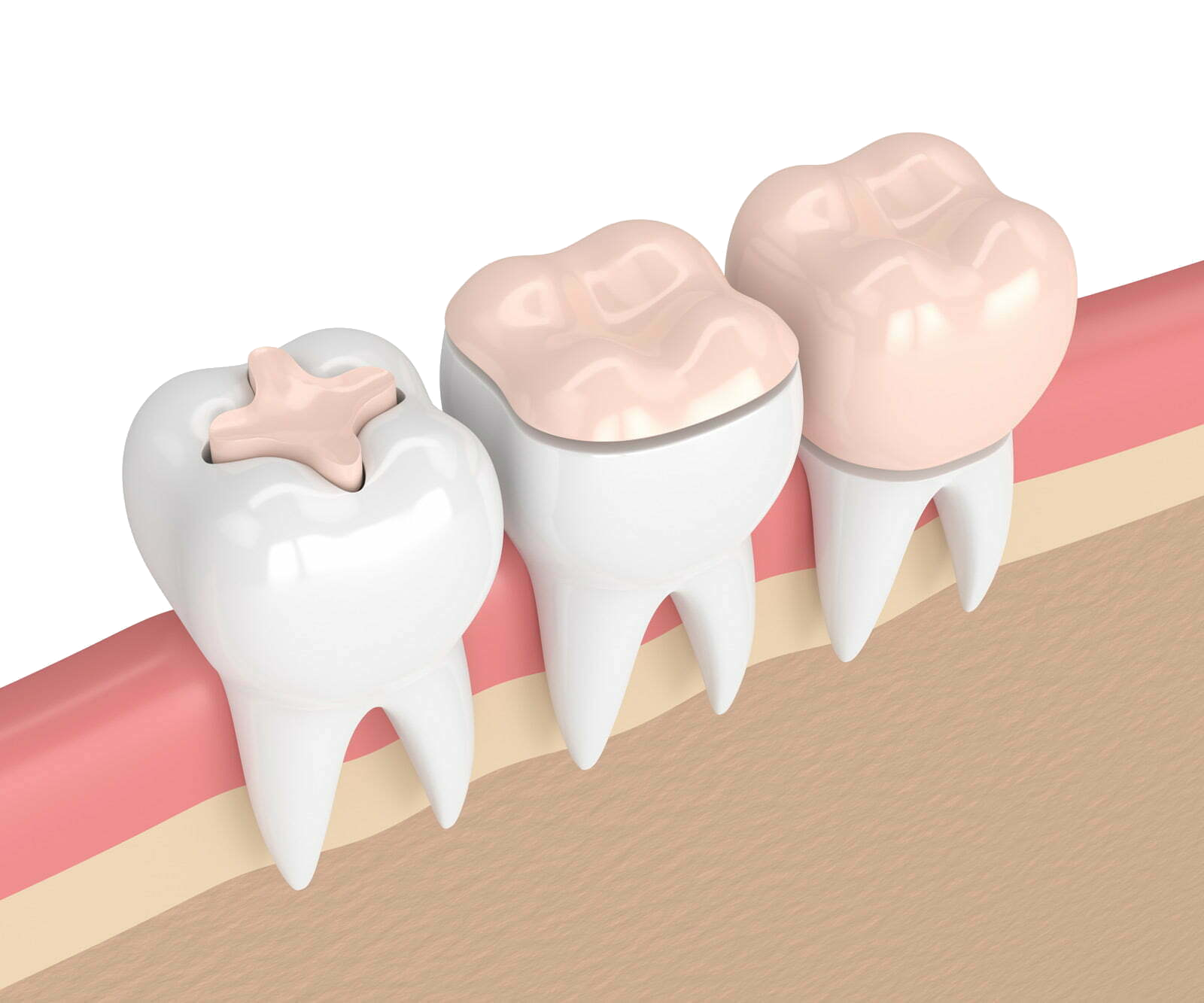 para-que-sirve-una-incrustacion-dental