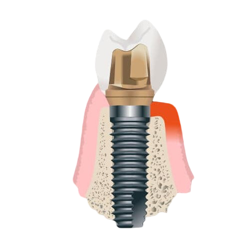 periimplantitis