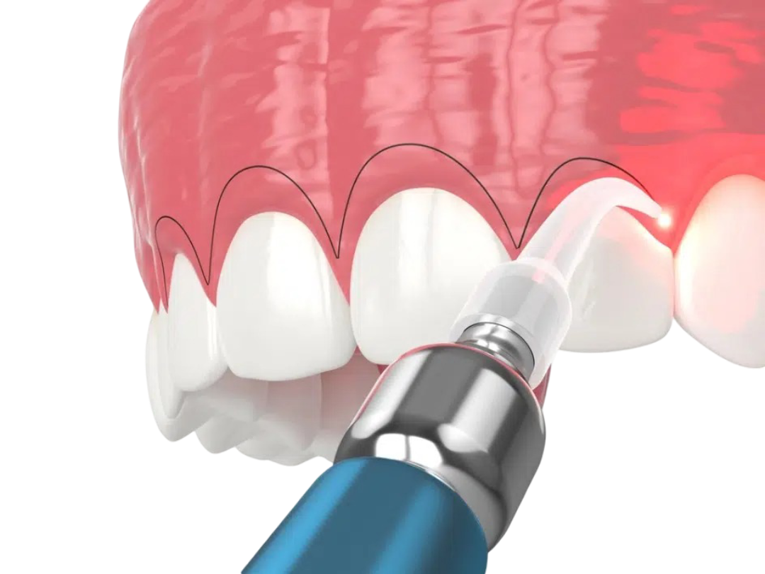 que es el contorneado dental