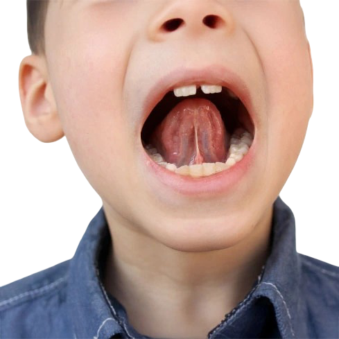 que-es-frenillo-lingual