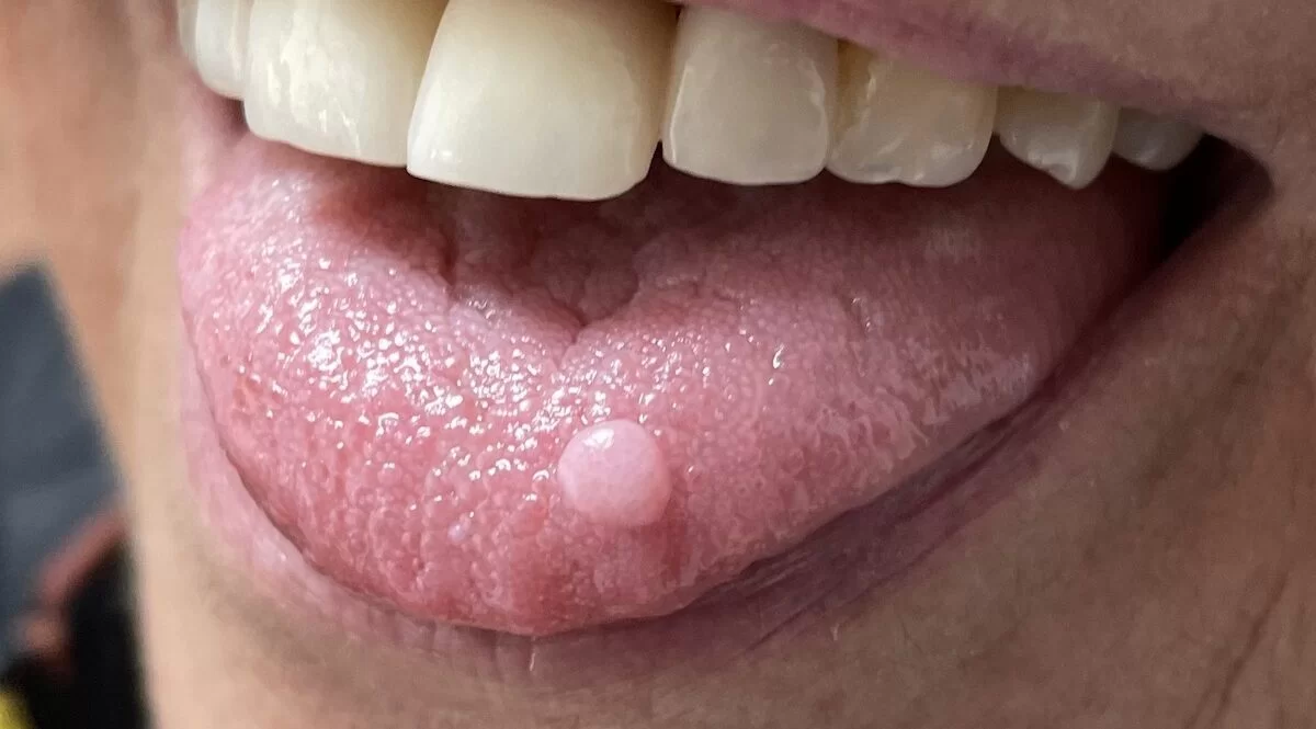 que son los granos en la lengua