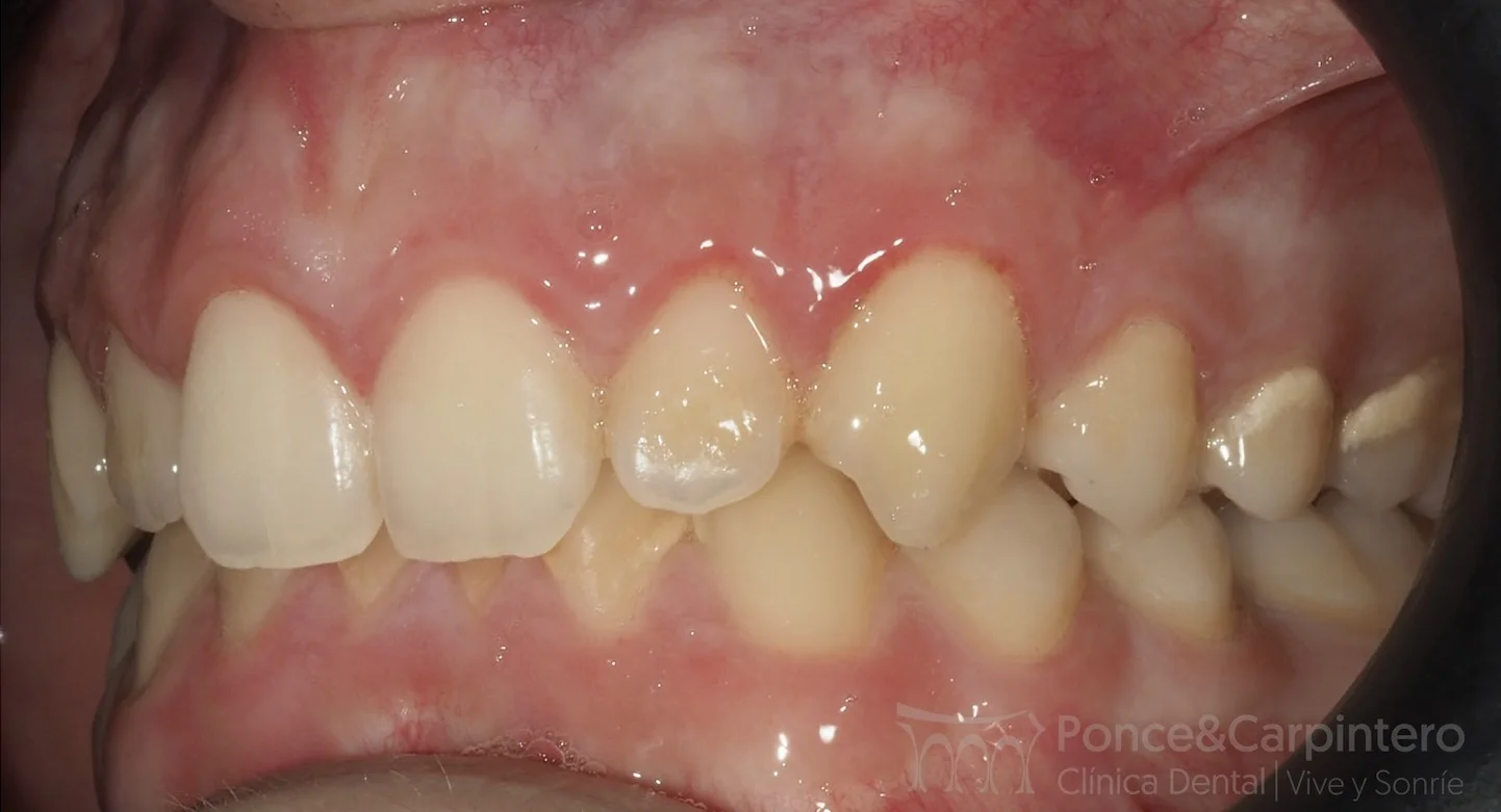 sobremordida-antes-111