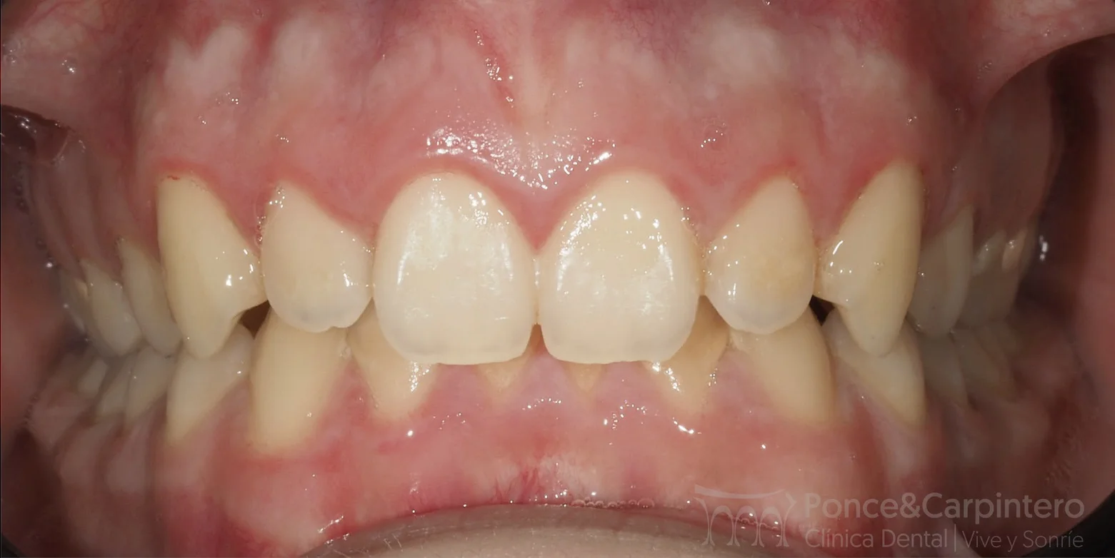 sobremordida-antes-2