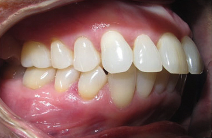 sobremordida-con-elasticos-1