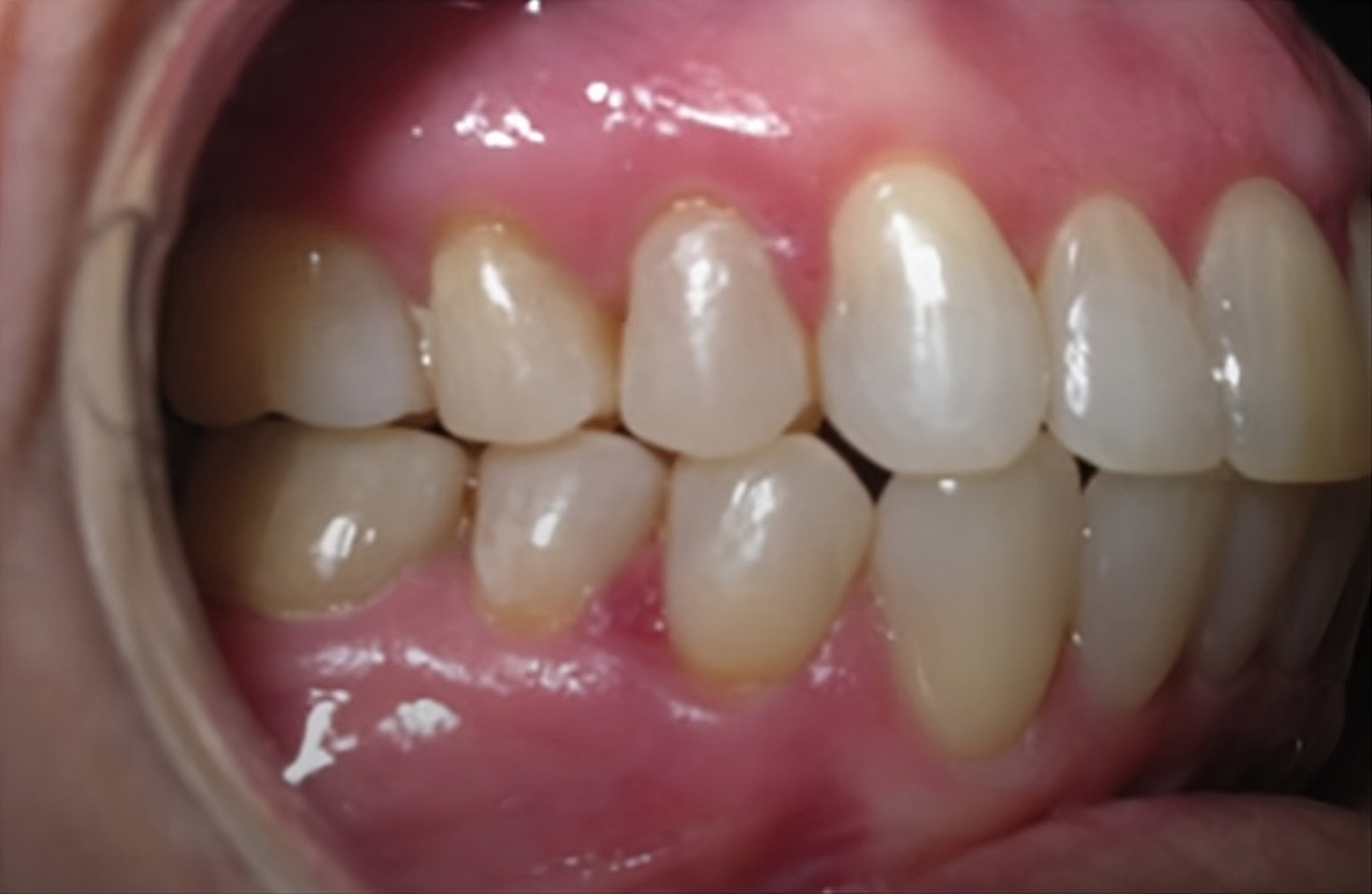 sobremordida-con-elasticos-2