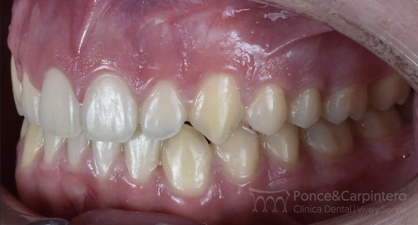 sobremordida-despues-111