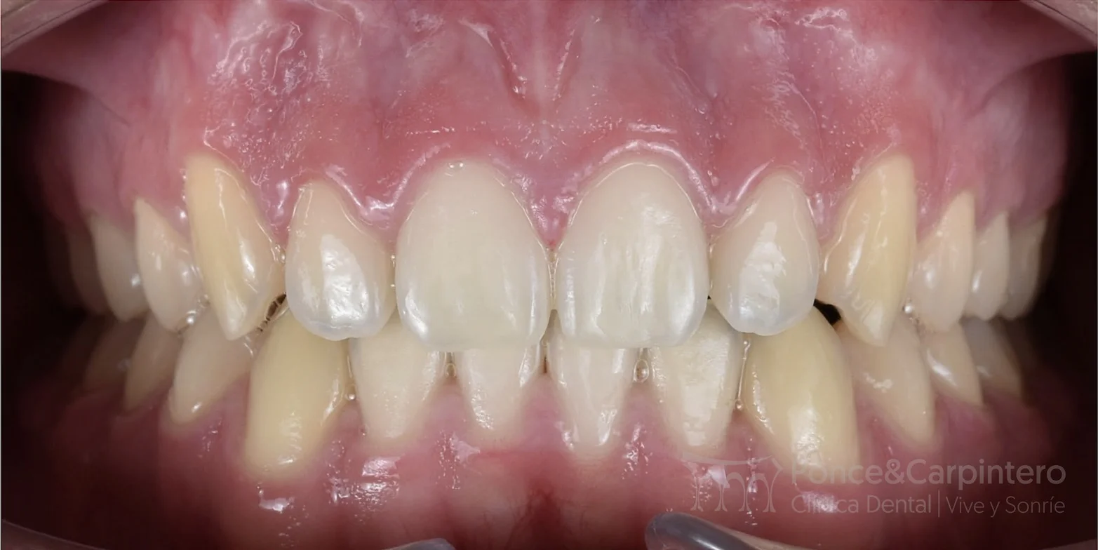 sobremordida-despues-2