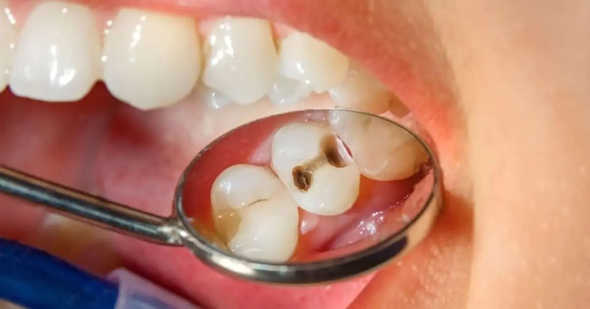 tratamiento-caries