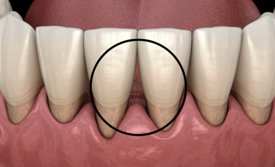 triangulos-negros-en-los-dientes